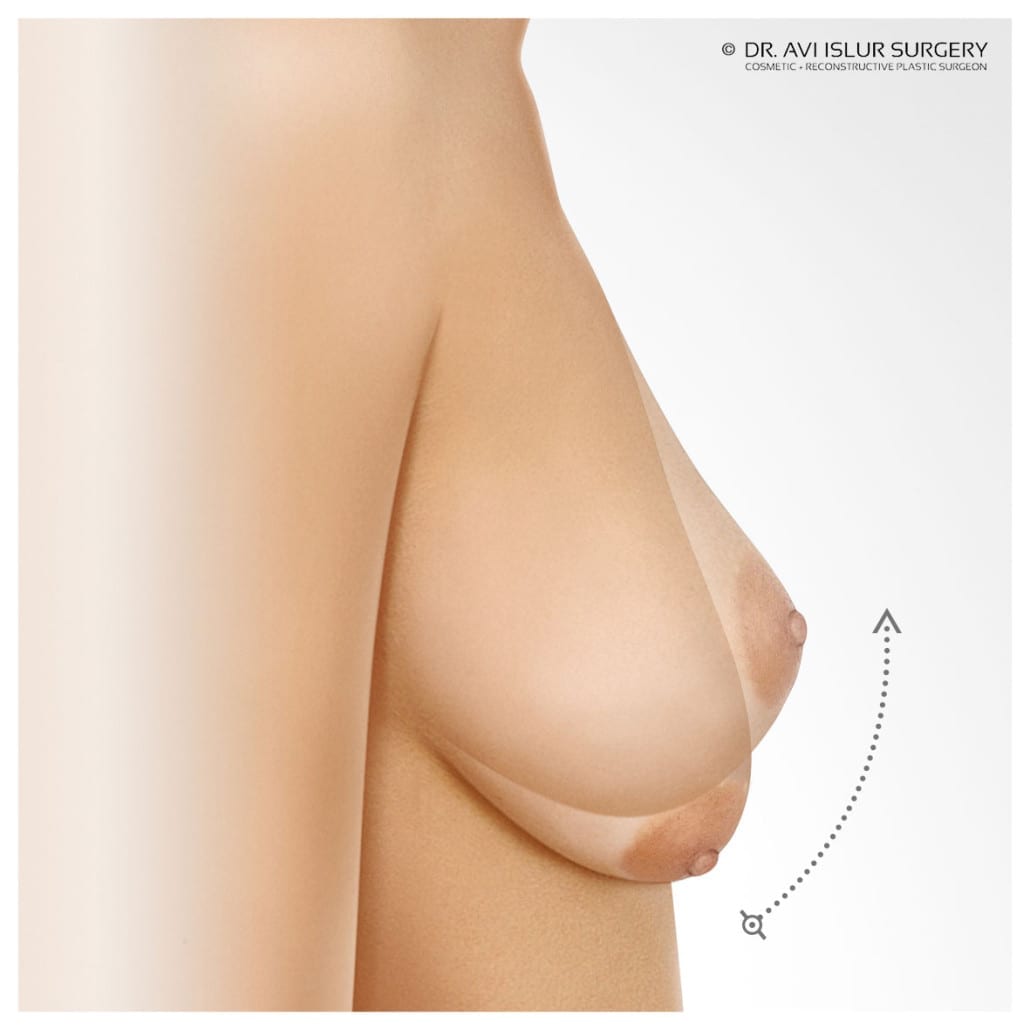 Breast Lift raising the position of the breast
