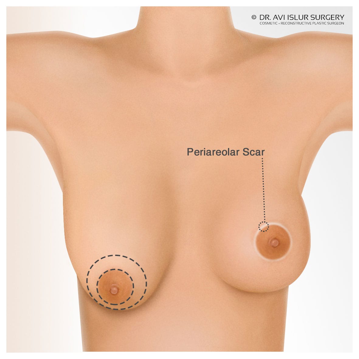 Illustration of a Periareolar Scar for Breast Lift Surgery Dr. Avi Islur Winnipeg, Manitoba, Canada The First Glance