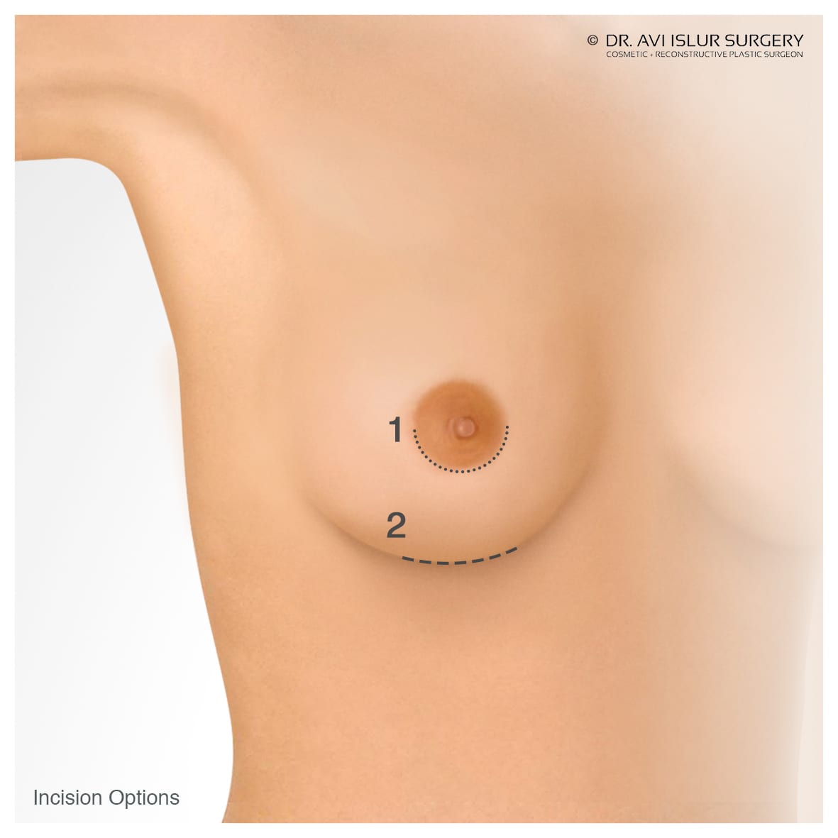 Illustration of Incision options for Breast Implants