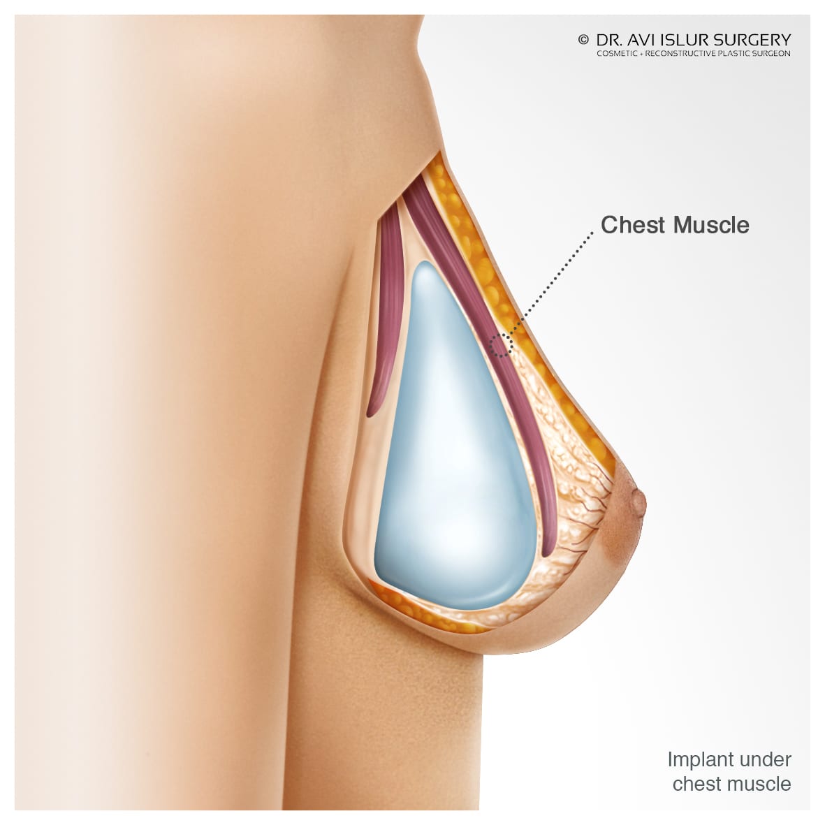 Breast Augmentstion 17