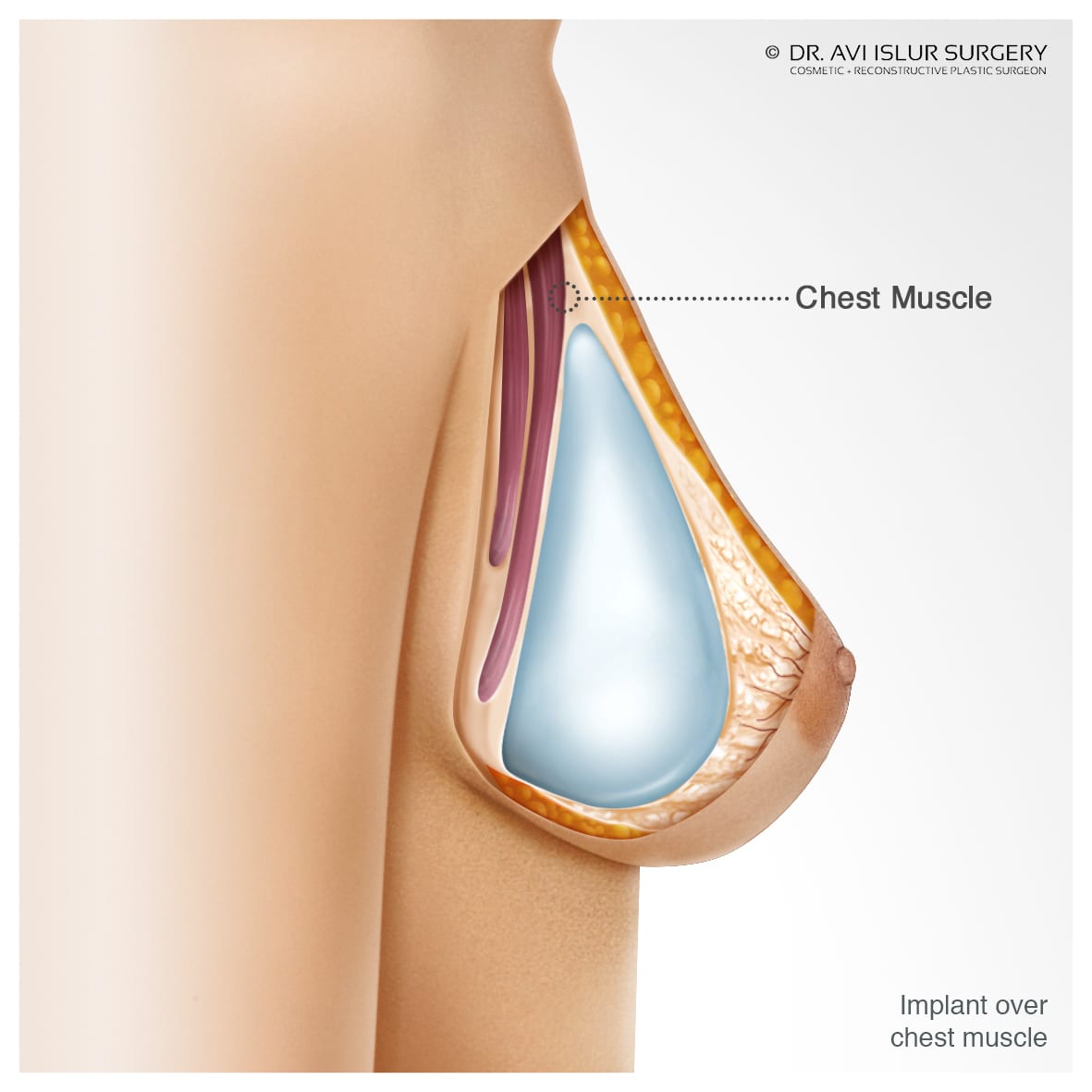 Illustration for Breast Implant Over the Chest Muscle Dr. Avi Islur Winnipeg, Manitoba, Canada The First Glance